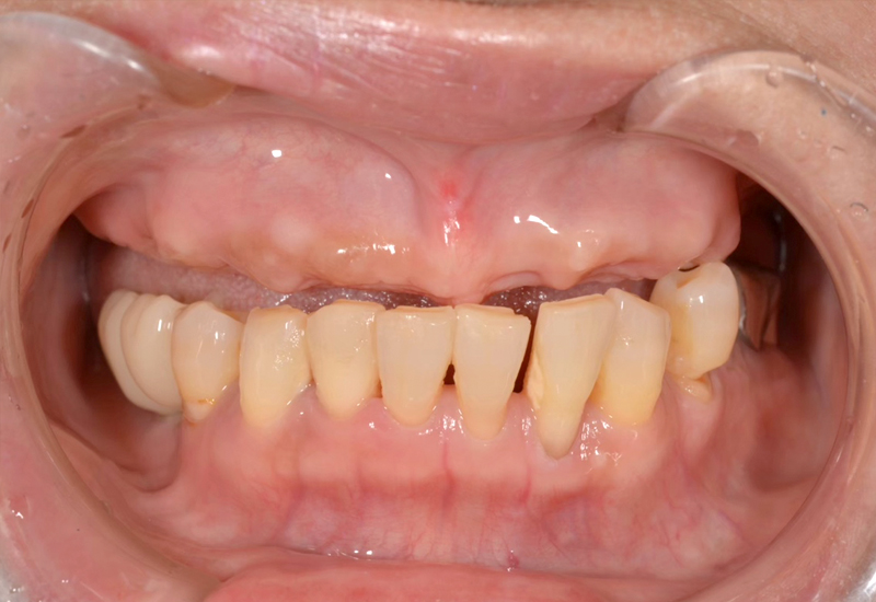 オールオン4術前写真