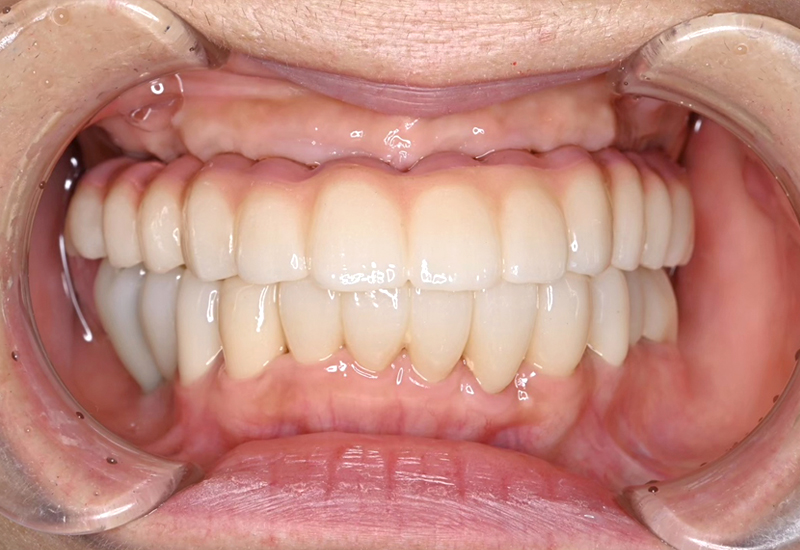 オールオン4術後写真