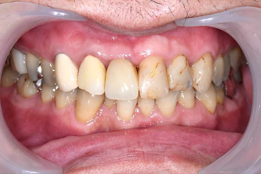 インプラント術後写真
