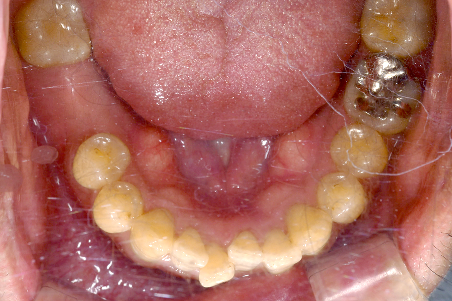 インプラント術前写真