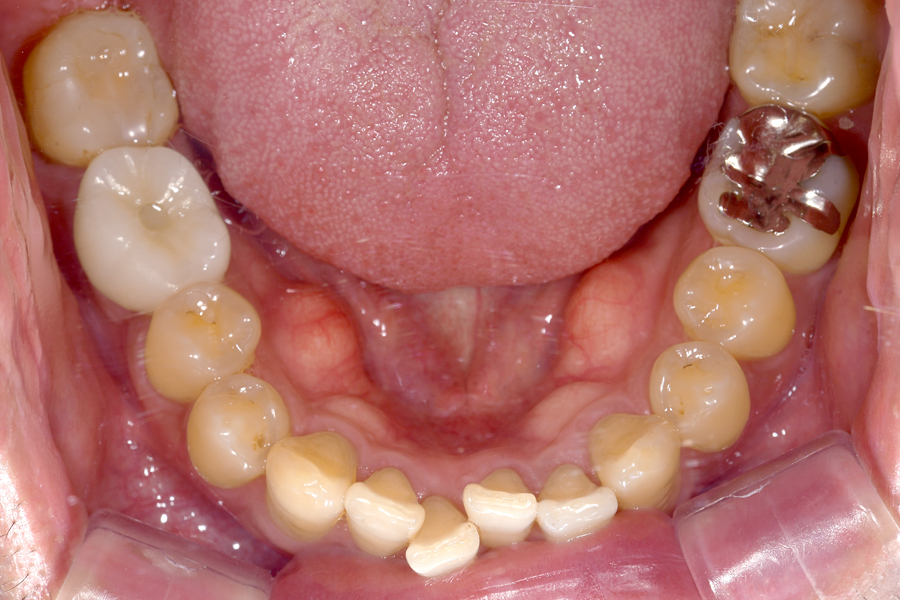 インプラント術後写真