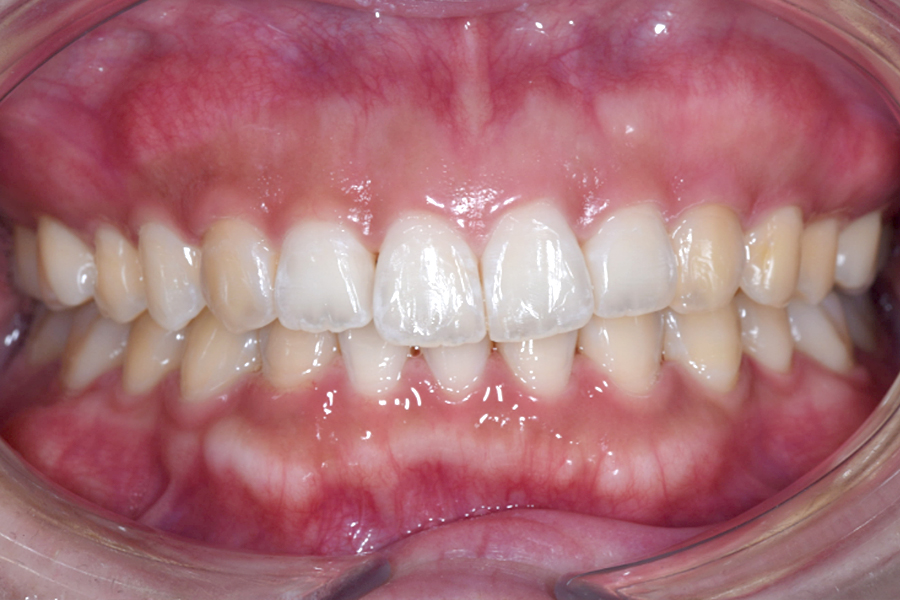 インビザライン術後写真