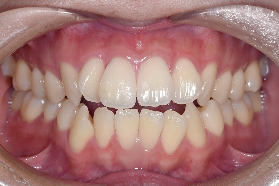 インビザライン術前写真