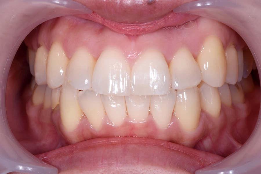 インビザライン術後写真