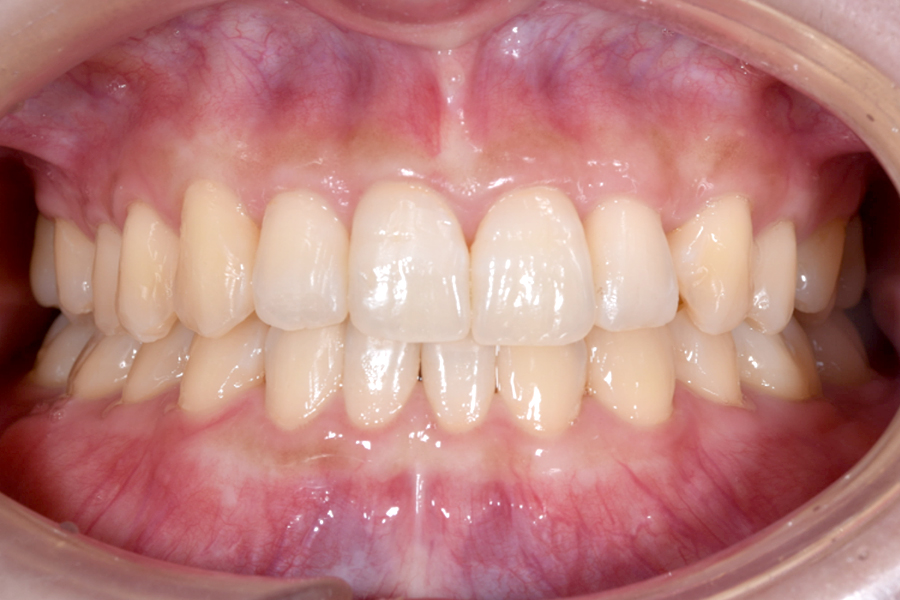 インビザライン術後写真