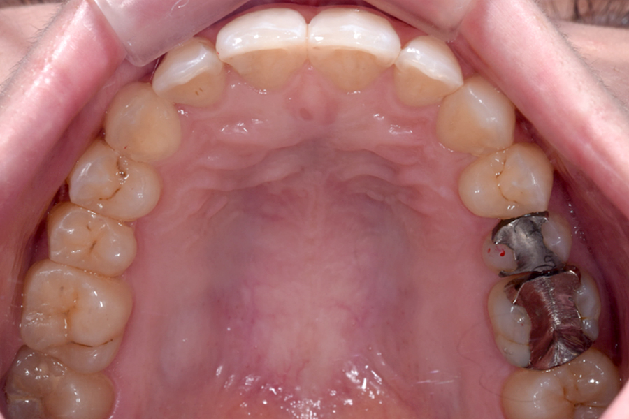 インビザライン術後写真