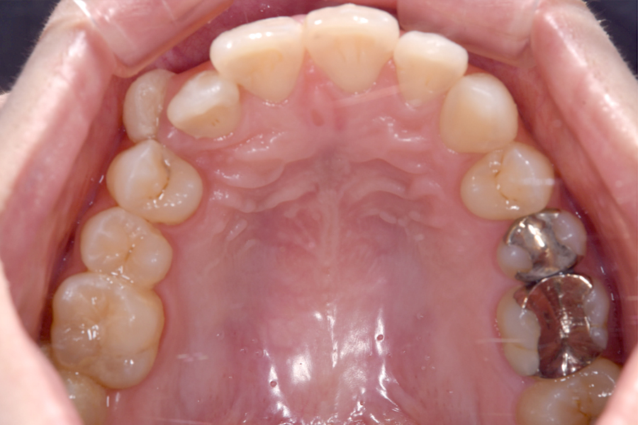 インビザライン術前写真