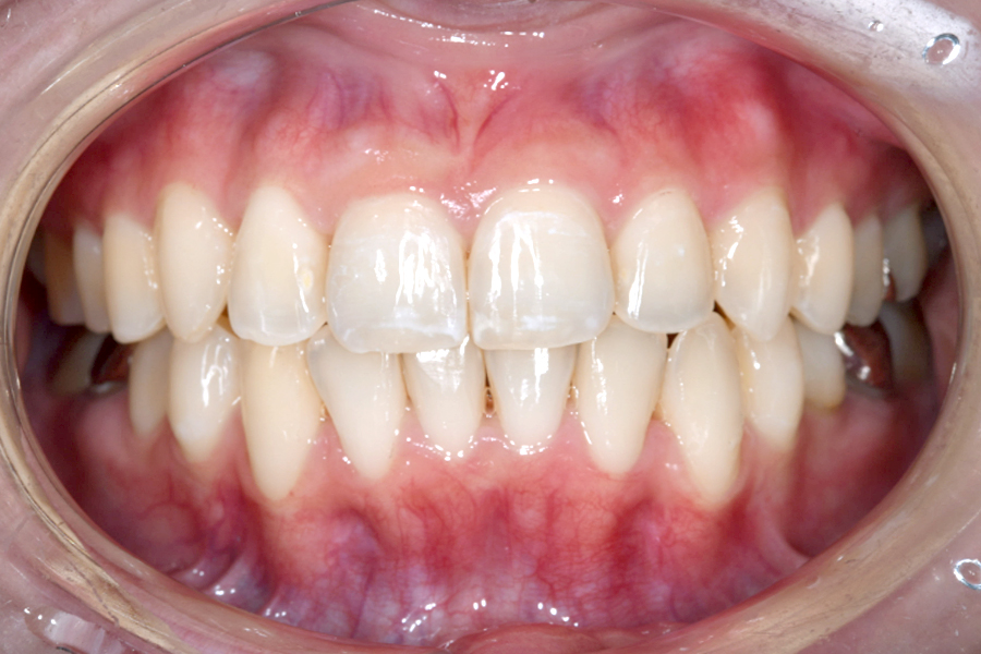 インビザライン術後写真