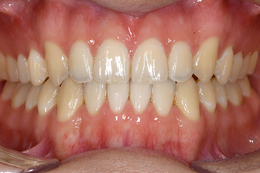 インビザライン術後写真