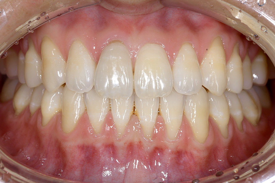 インビザライン術後写真