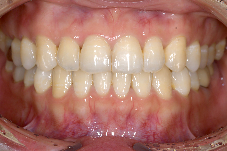 インビザライン術後写真