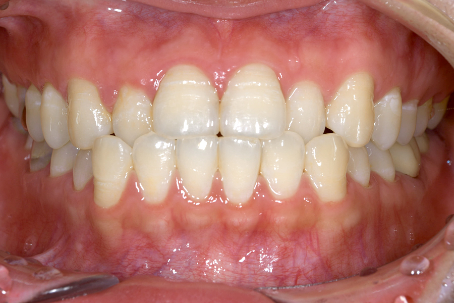 インビザライン術前写真