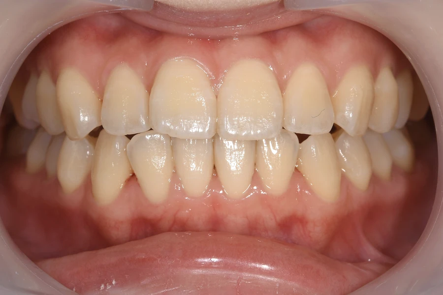 ホワイトニング術前写真