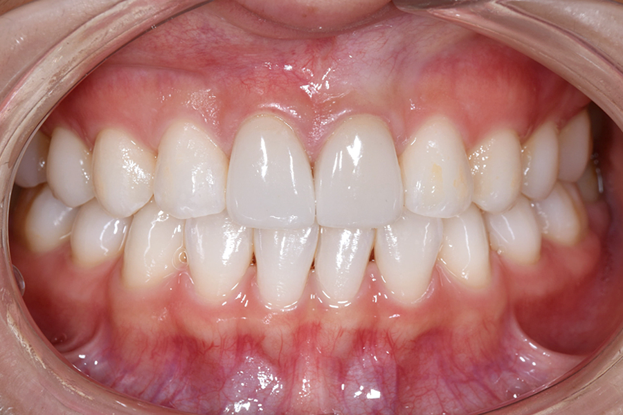 ホワイトニング術後写真
