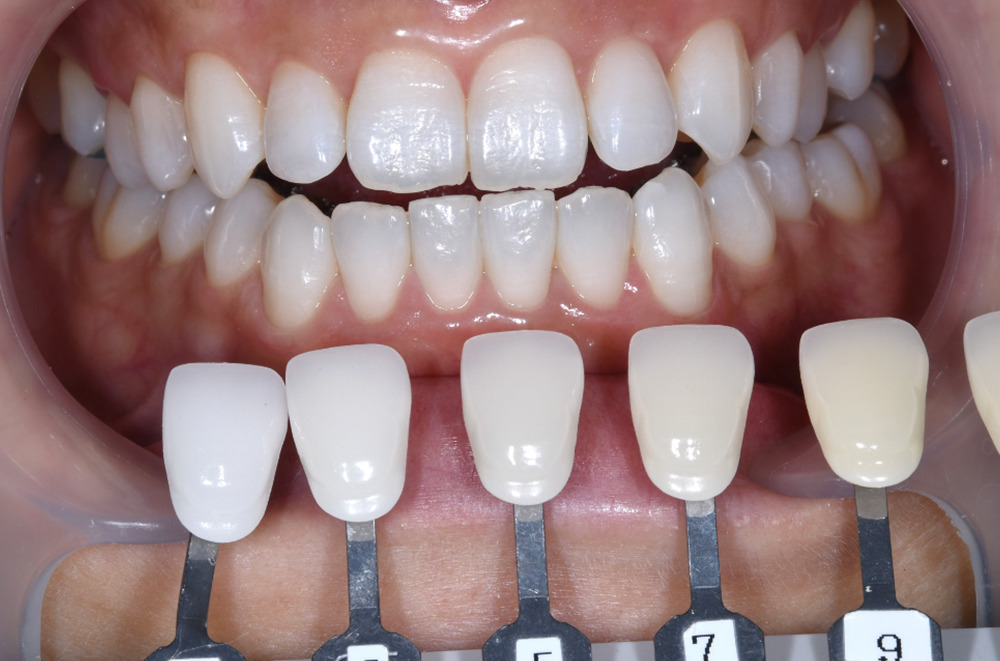 ホワイトニング術後写真