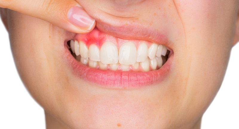 一般歯科　　歯ぐきの出血